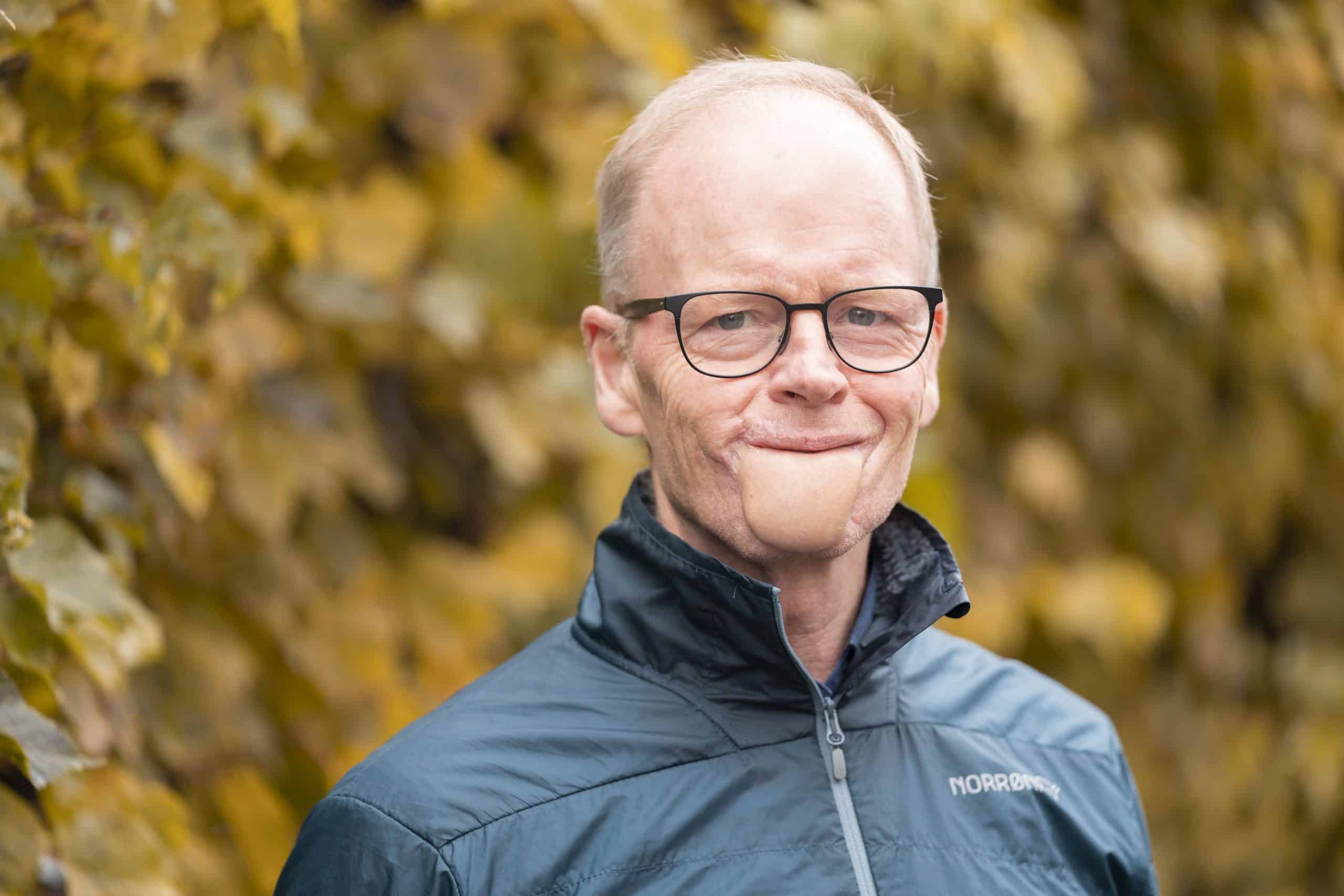 ENDRET ETTER ULYKKEN- John Erik Sundby har hatt flere operasjoner i ansiktet. Hakepartiet består av muskler og hud fra et parti på låret hans. Foto- VG Partnerstudio.
