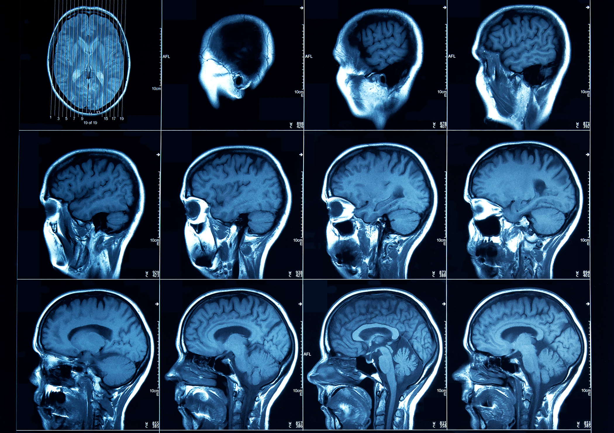 CT scanninger av et menneske hode