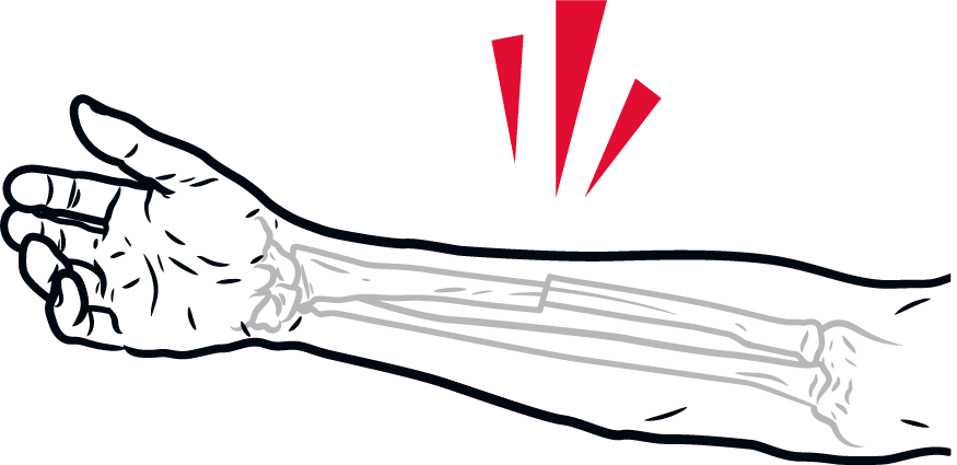 Illustrasjon av brudd i arm etter sykkelulykke