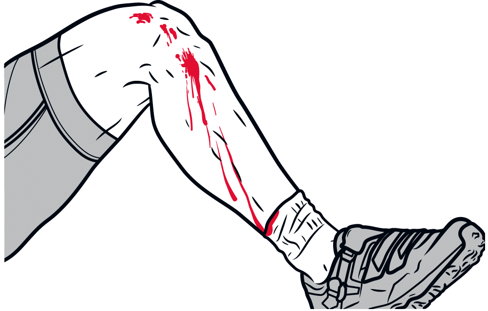 Illustrasjon av blødende bein etter ulykke på sykkel