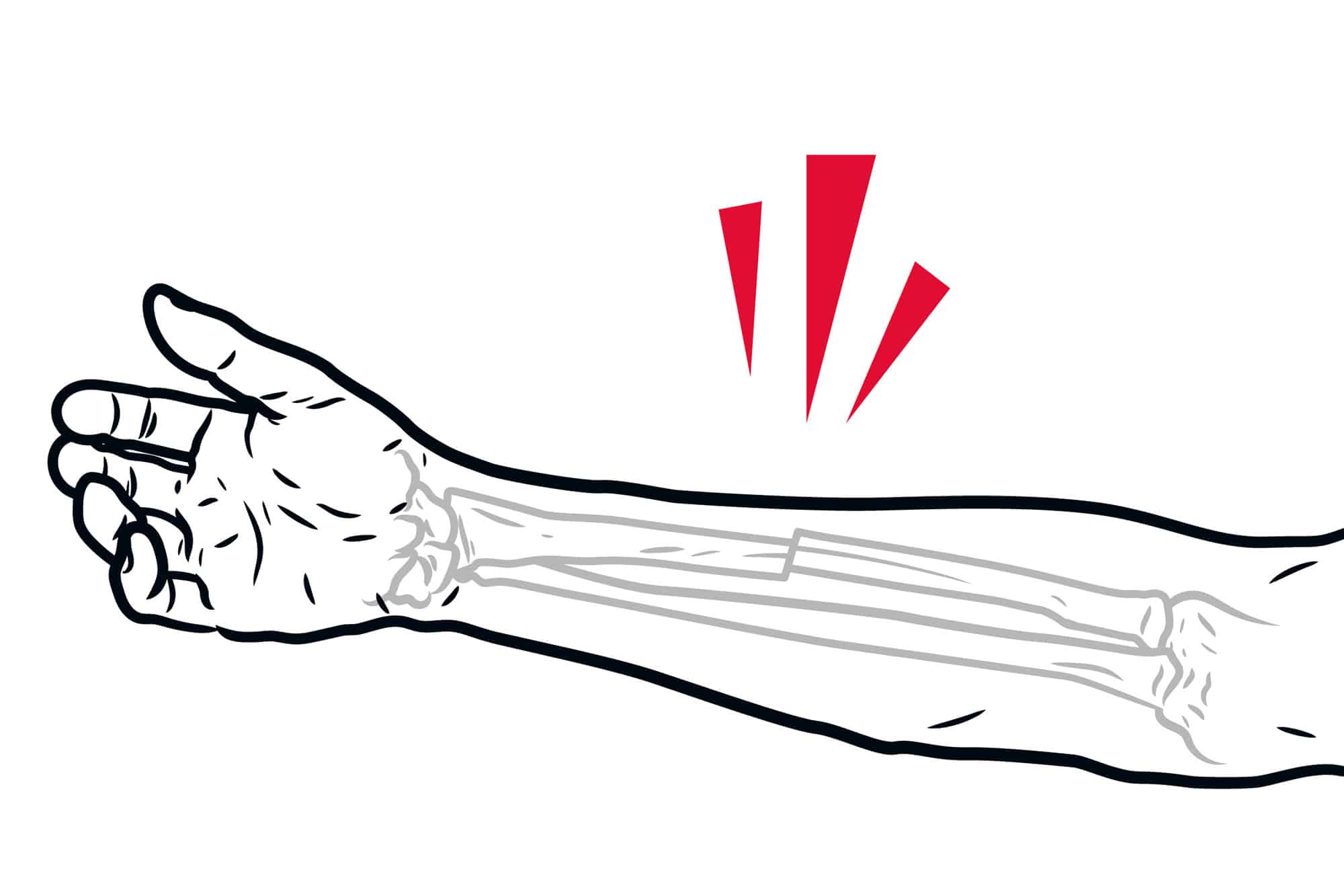 Illustrasjon av brudd i underarmen.
