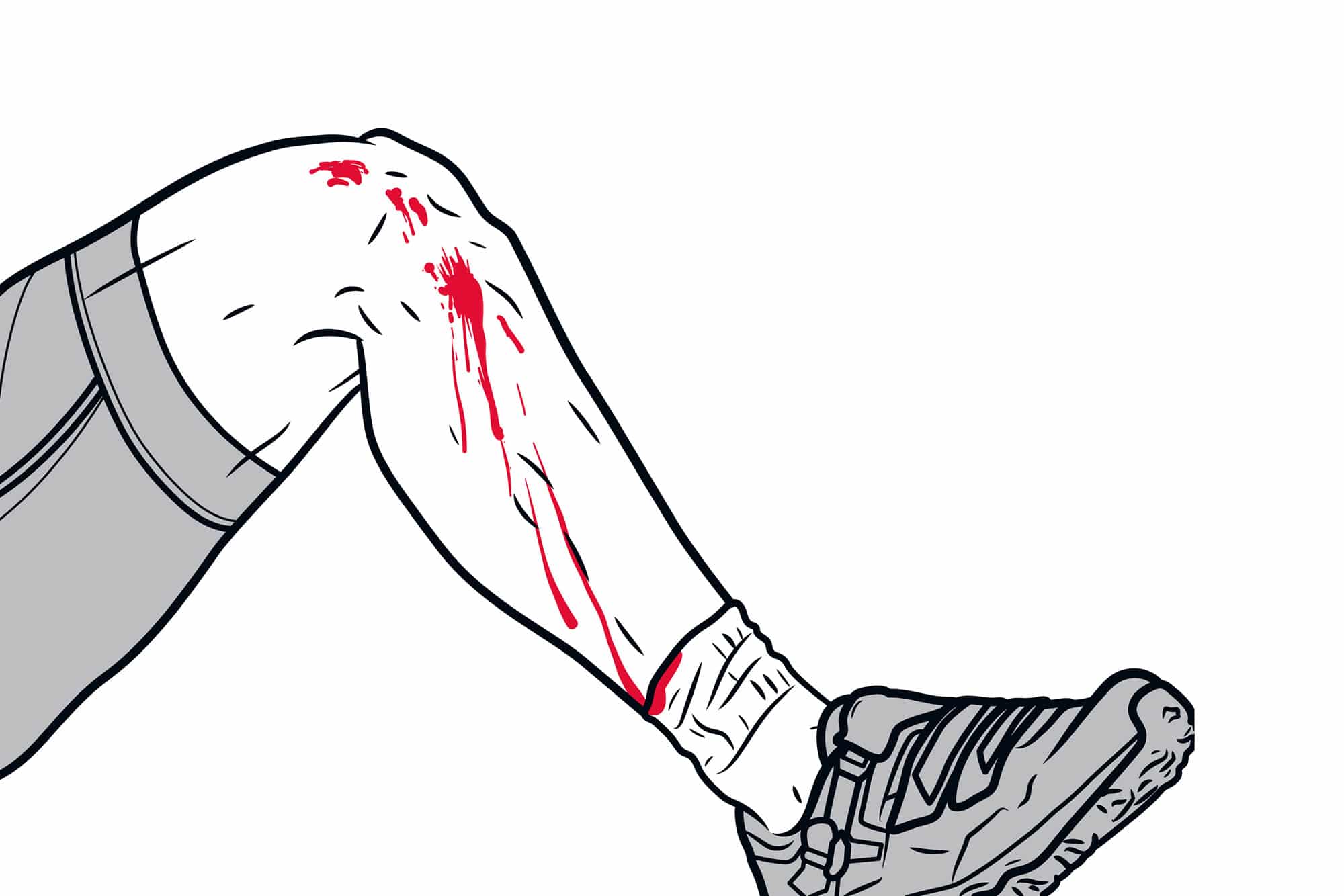 Illustrasjon av blødende sår på beinet.