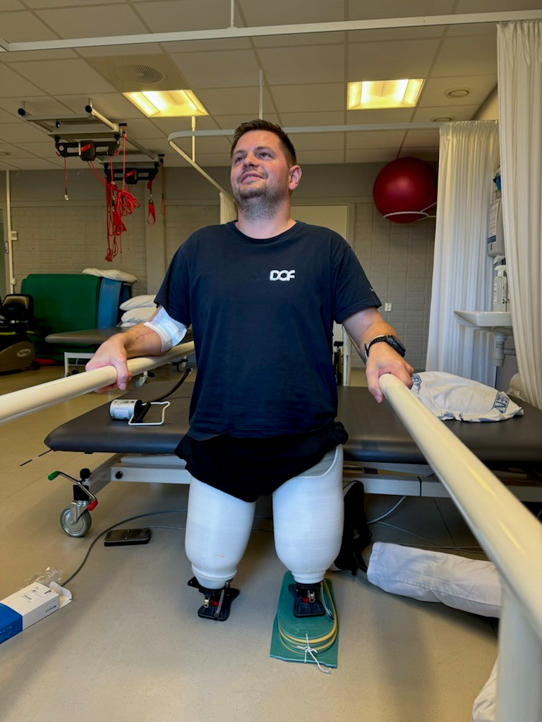Bilde av Marcus med proteser på beina. De første skrittene med proteser i september 2024.