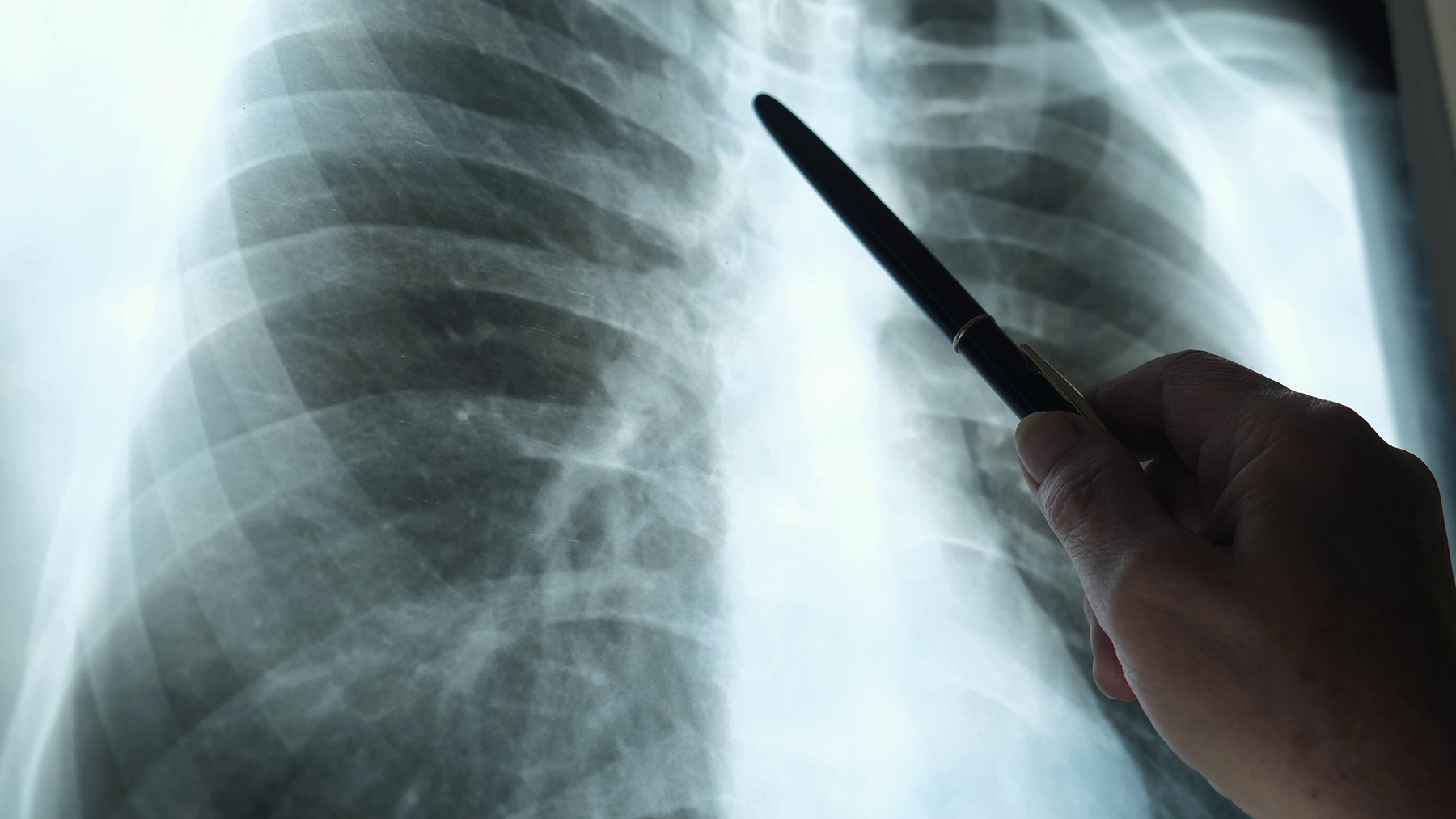 Røntgen av brystkasse